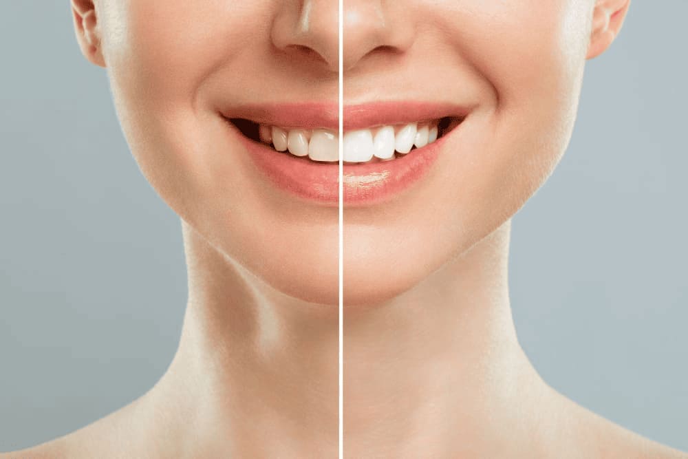 blanqueamiento-dental-profesional-en-morelia
